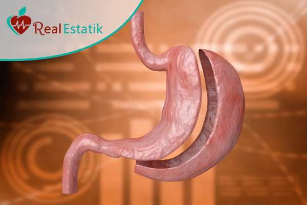 sleeve gastrectomy in turkey